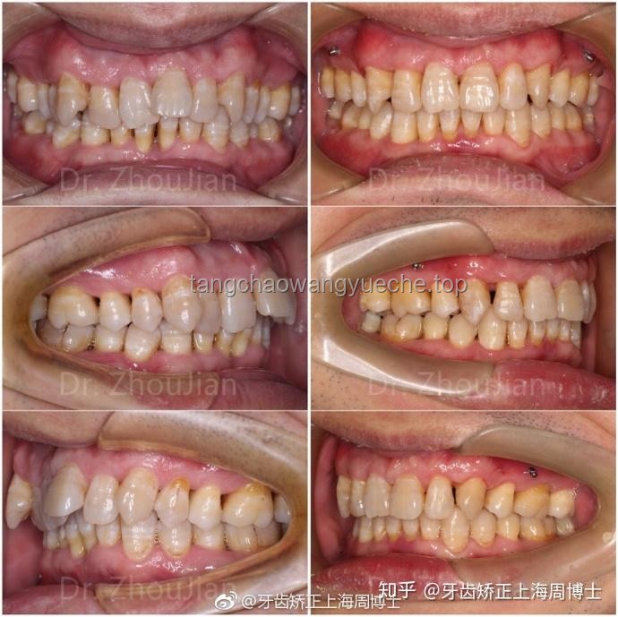 韦神门牙脱落背后的牙周炎治疗与行业洞察